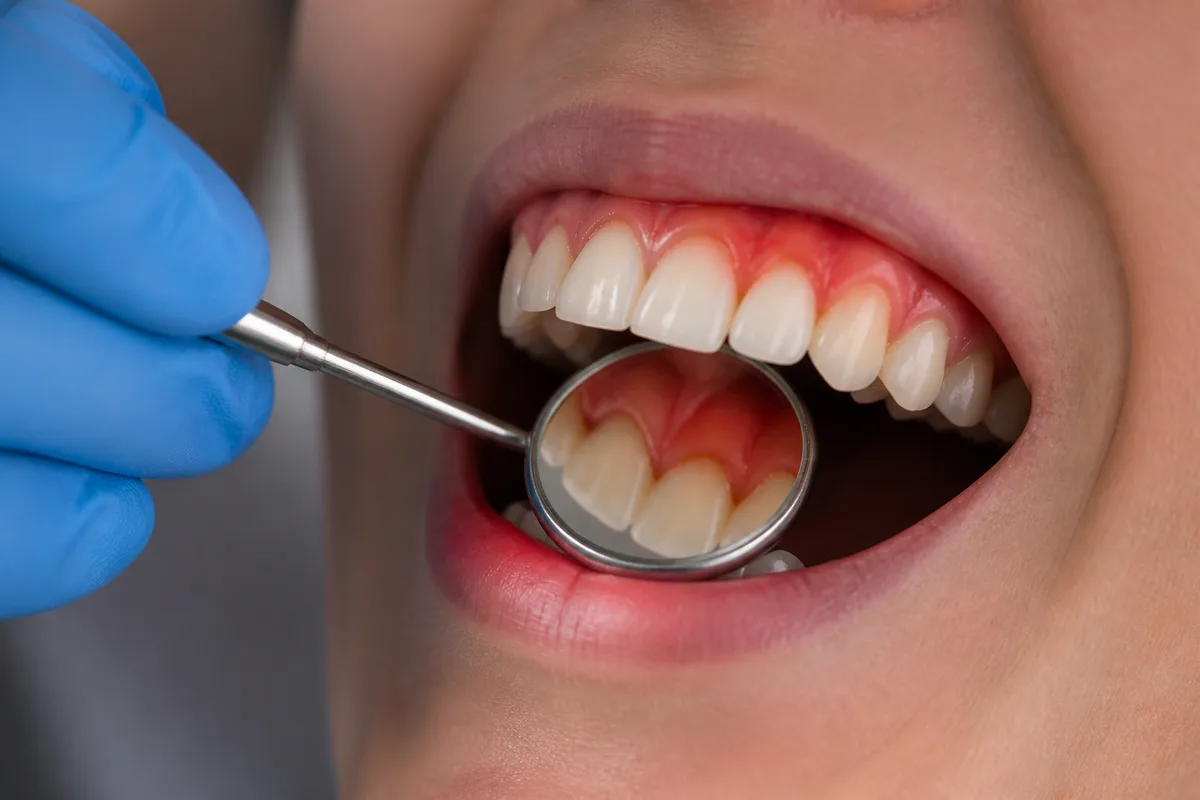 Why Do My Gums Bleed When I Brush?