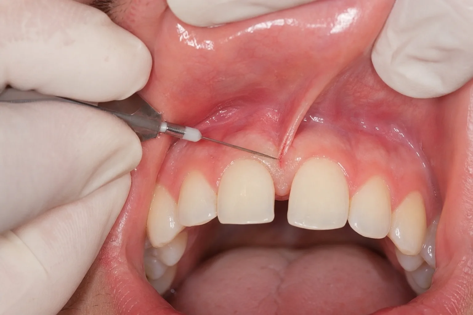 Frenectomy