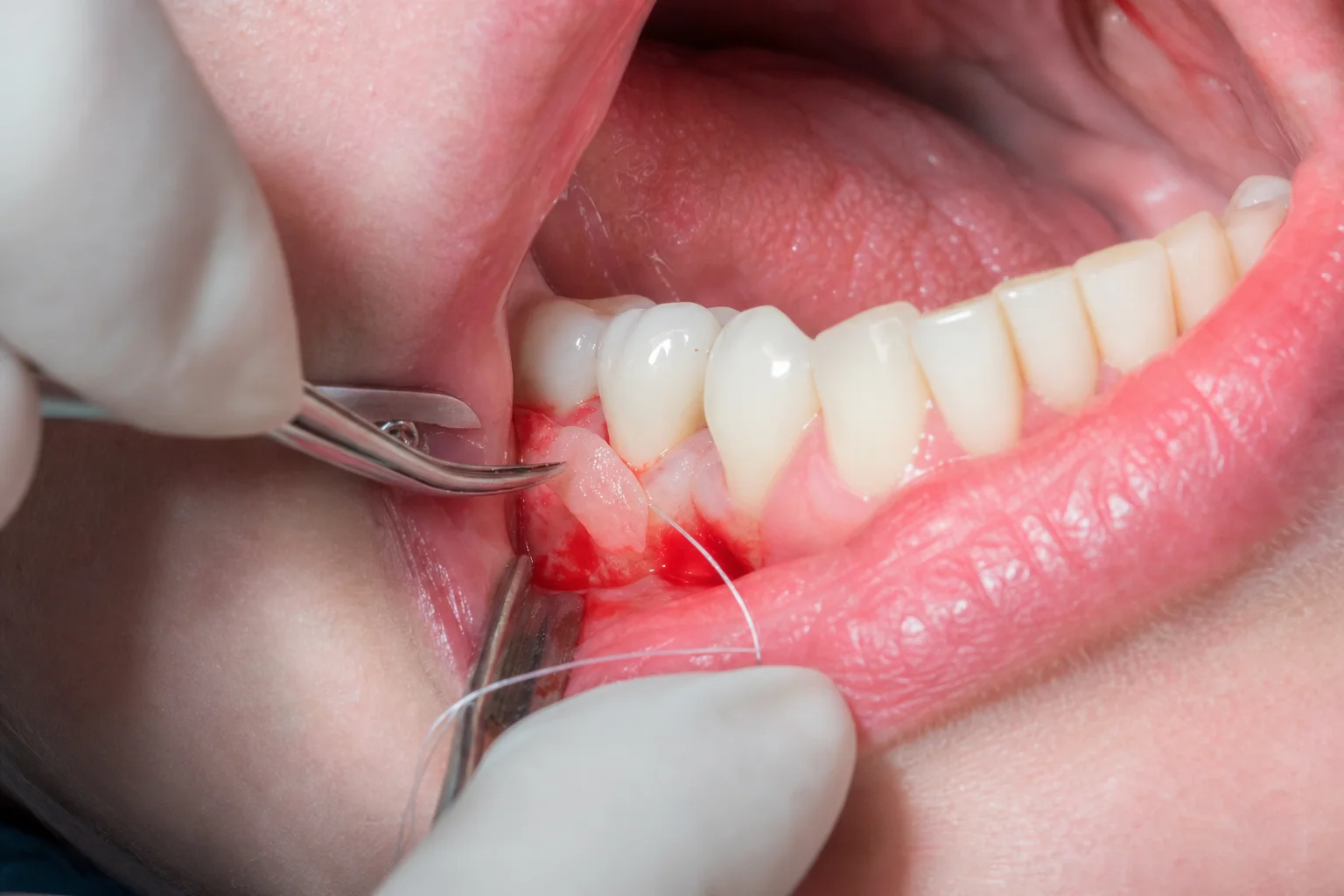 Gum Grafting