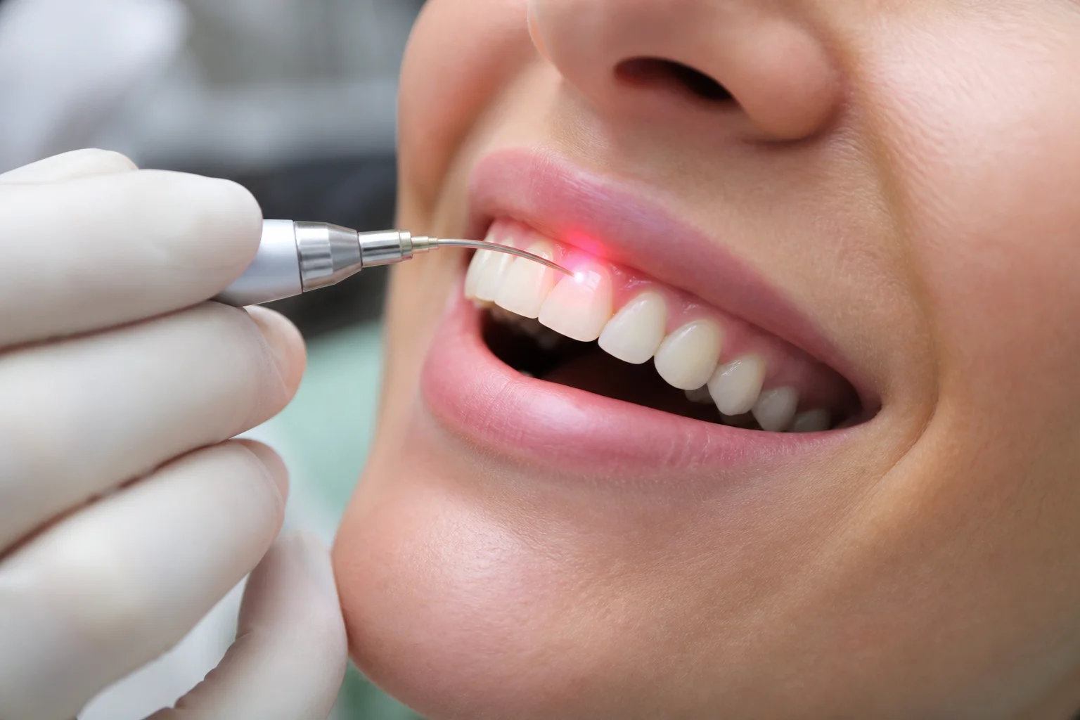 Laser Gum Therapy