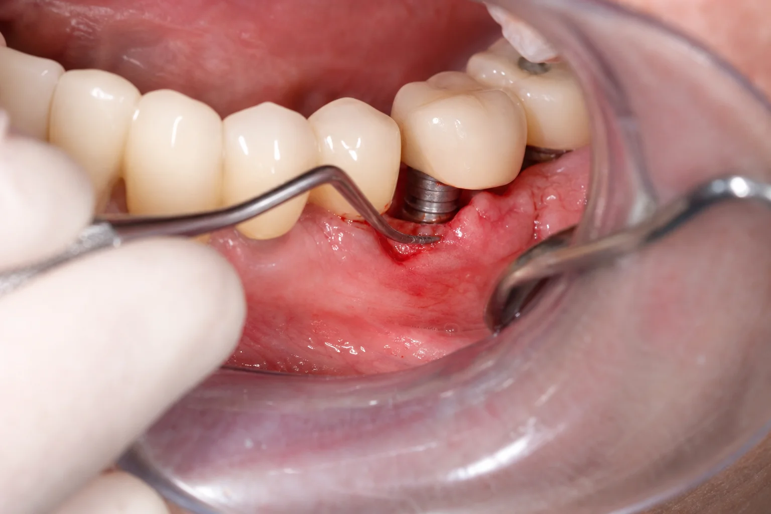 Peri-Implantitis Treatment