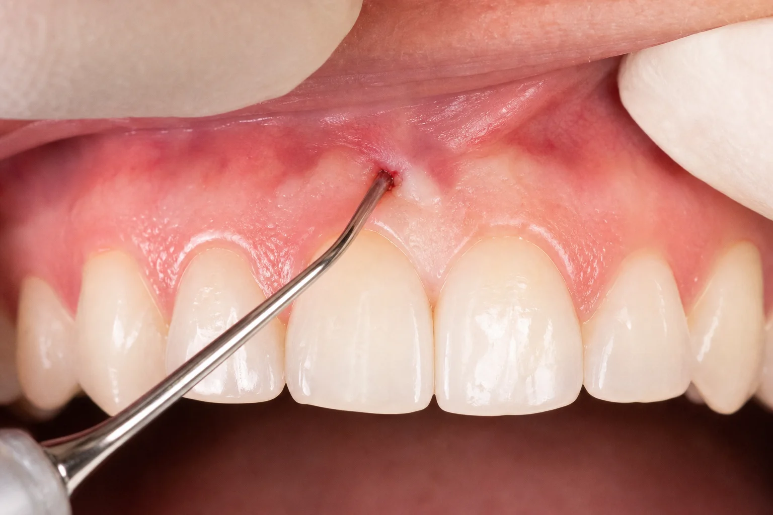Pinhole Surgical Technique (Scalpel-Free Gum Recession Treatment)