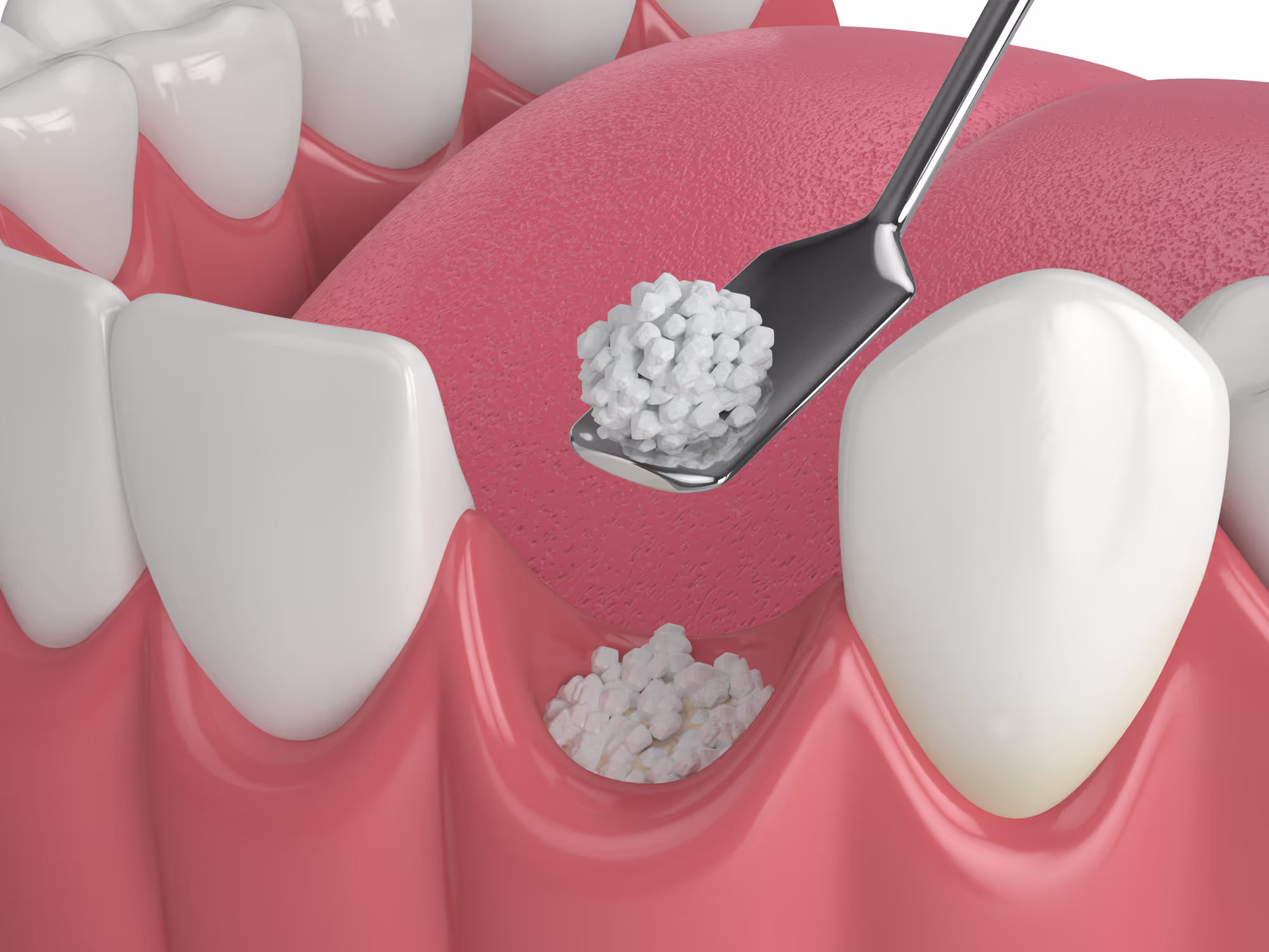 Bone grafting care