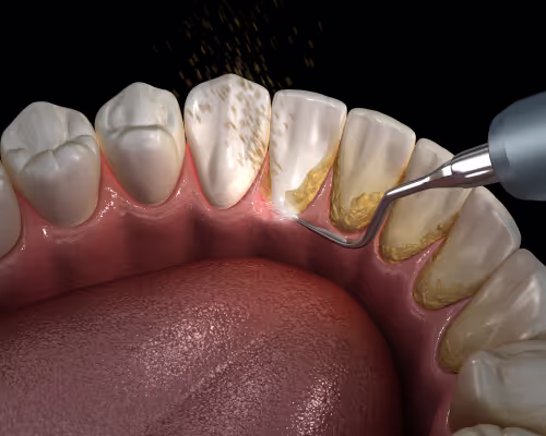Deep Cleaning (Scaling and Root Planing)