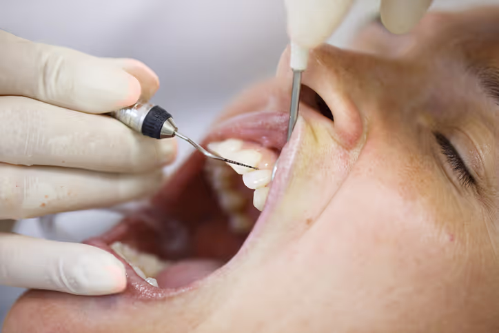 Periodontal Maintenance